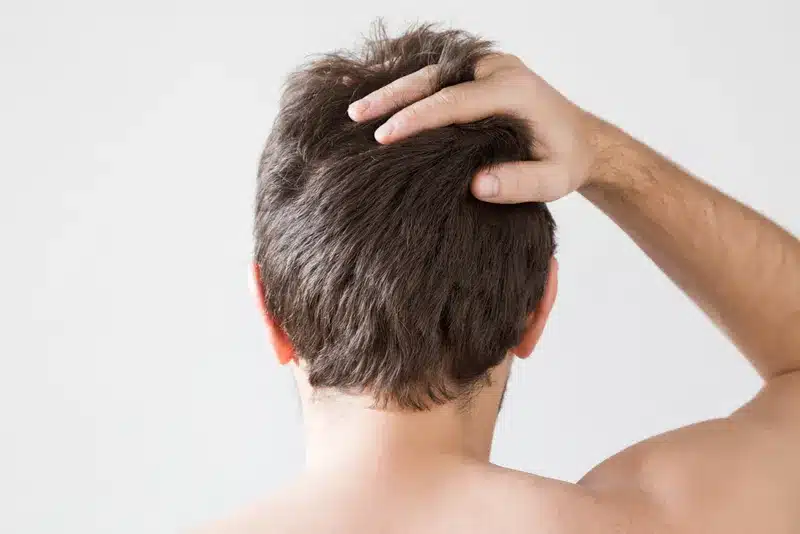 Finasteride
