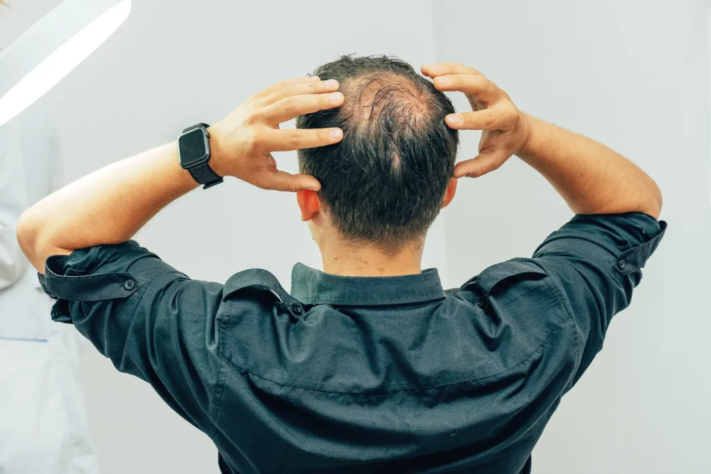 Finasteride