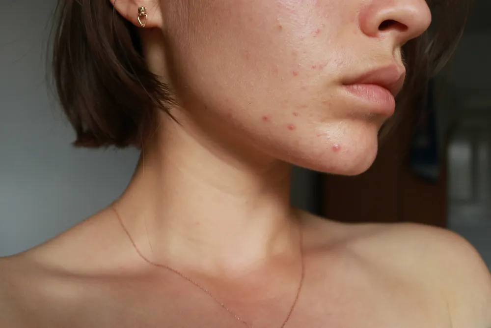 tretinoin