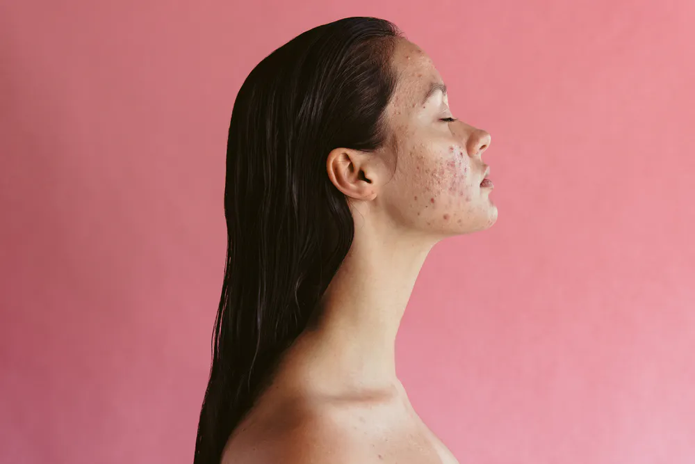 Tretinoin