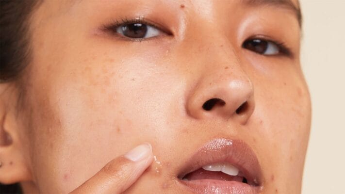 Cream for Pimples and Dark Spots