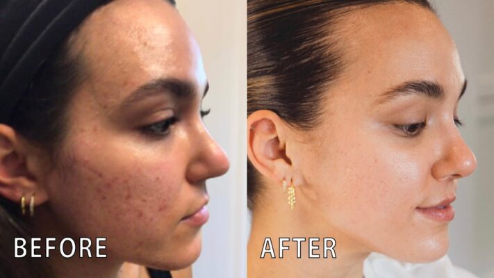 Birth Control for Acne