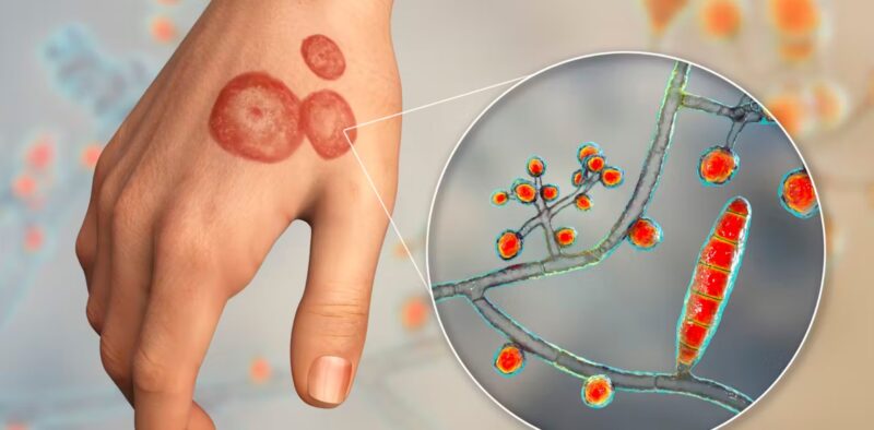 Fungal Infection