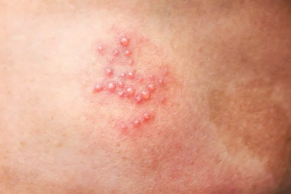 Genital Herpes Symptoms in Women