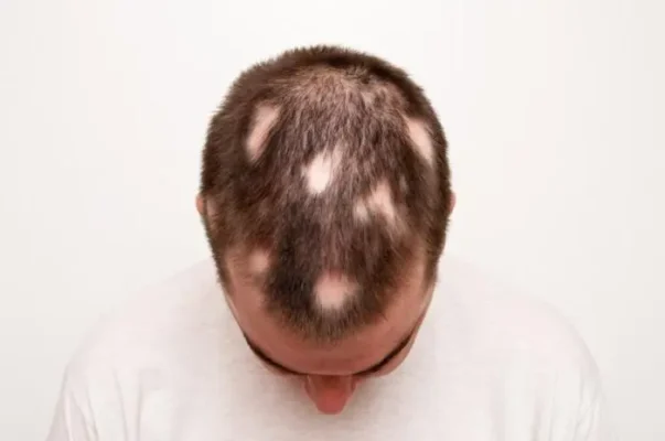 Hair Loss
