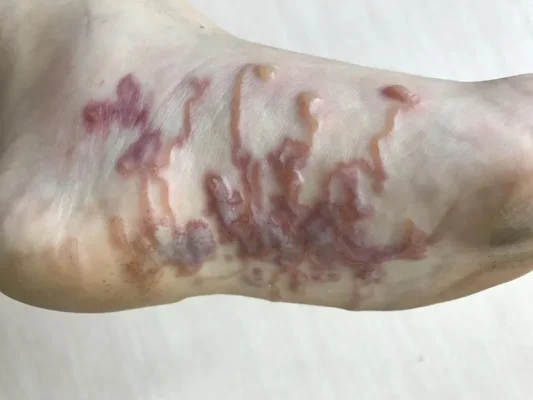Hookworm Infection