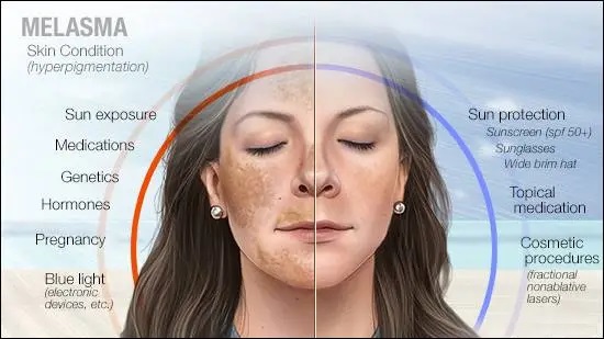 How to Treat Hyperpigmentation Disorders Such as Melasma and Dark Spots