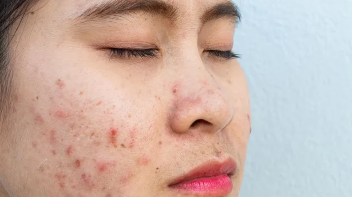 Skin Disorders