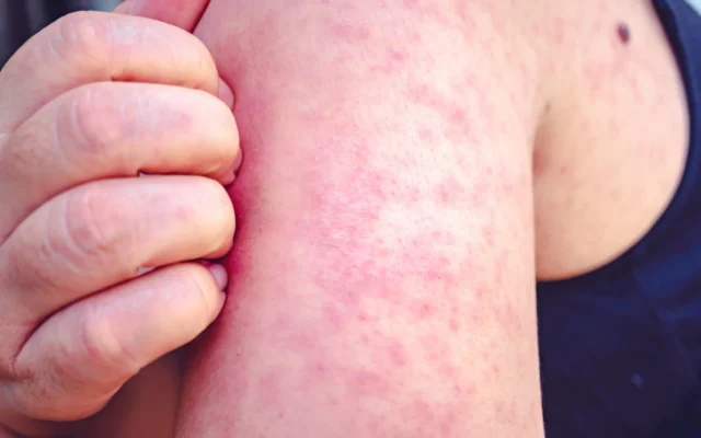 Measles