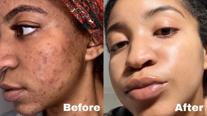 Acne Scars