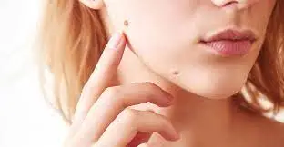 mole