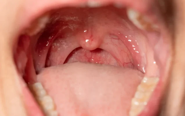 Cobblestone Throat