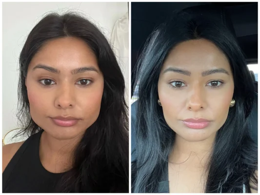 Masseter Botox