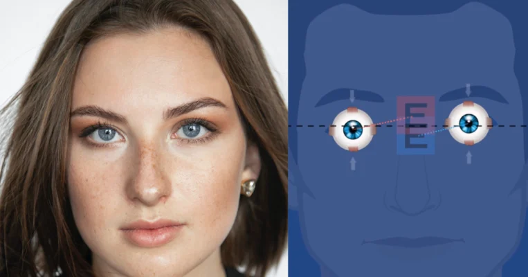 Binocular Vision Dysfunction