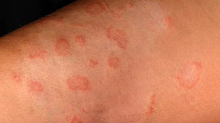 Ringworm